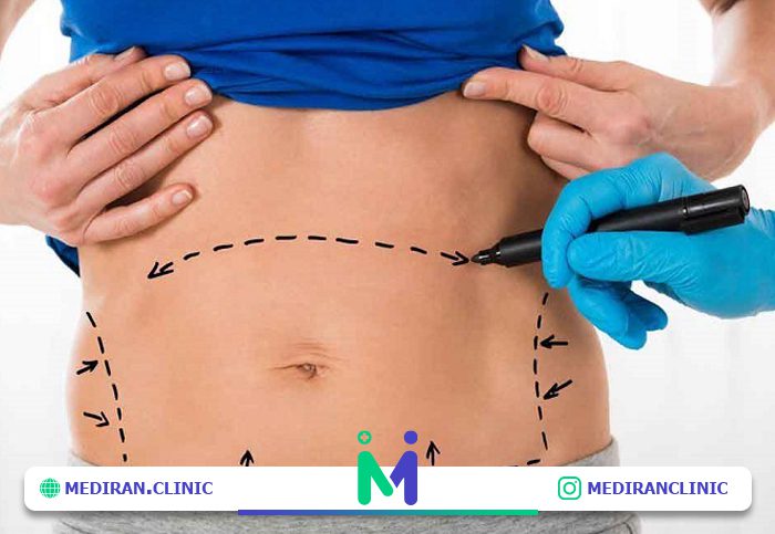 پیشگیری از شلی پوست بعد از لیپوساکشن