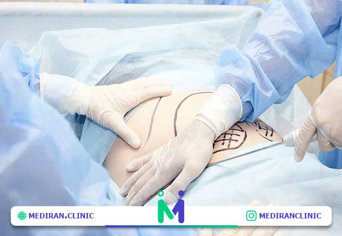 پیشگیری از افتادگی پوست بعد از لیپوساکشن