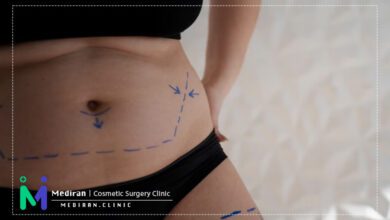 بارداری بعد از ابدومینوپلاستی