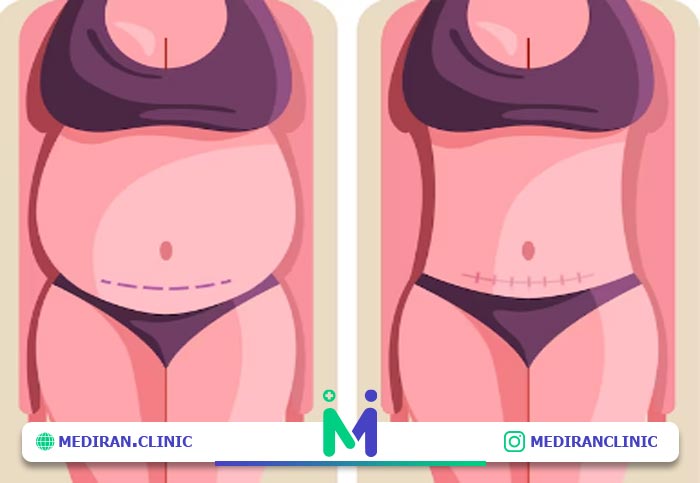 تاثیرات بارداری بر ابدومینو