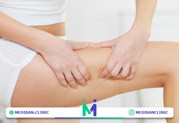 لیفت ران راهی برای خوش فرمی پا