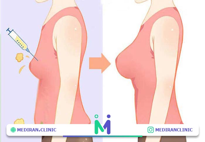 چگونگی-انجام-عمل-تزریق-چربی-به-سینه