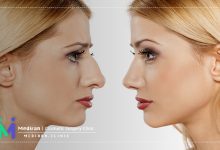 ورزش قبل عمل جراحی بینی