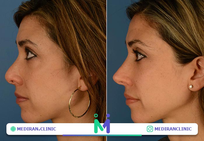 بهترین کاندیدا برای جراحی ترمیم بینی
