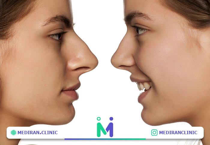 روش های جراحی بینی