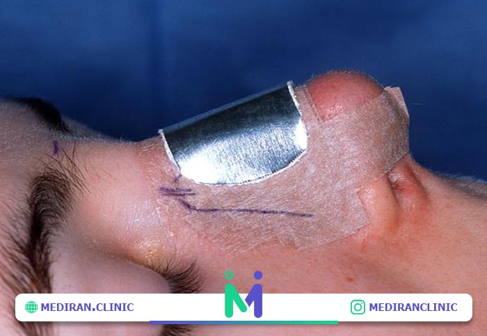 نکات استفاده از اسپلینت
