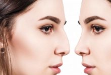 درمان خانگی انحراف بینی