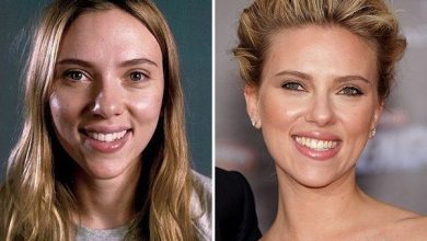 تاثیر جراحی بینی بر زیبایی چهره