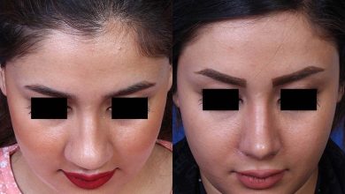 علت برگشت بینی استخوانی پس از عمل