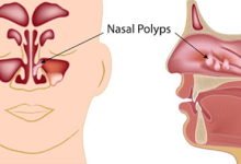 از کجا بفهمیم پولیپ بینی داریم