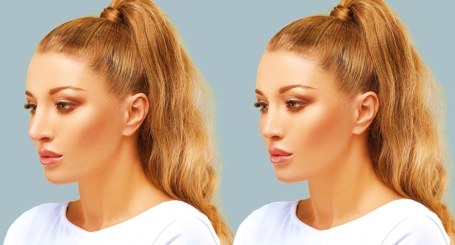 افتادگی نوک بینی بعد از عمل 