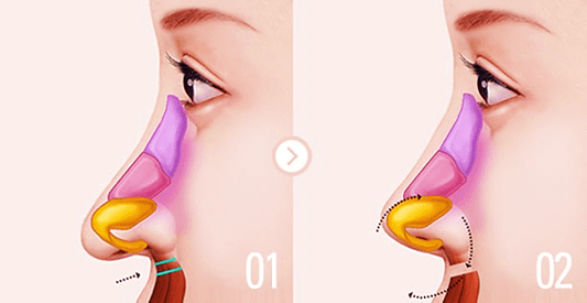 افتادگی نوک بینی بعد از عمل