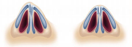 عمل ترمیمی بینی سرپایی چگونه است